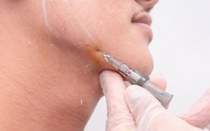 22G Cannula for the Jawline