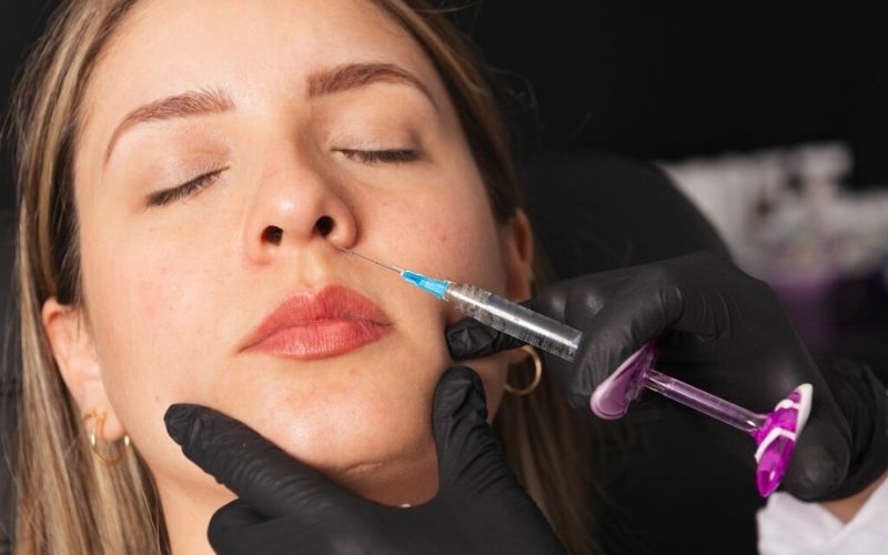 23G Cannula for Nasolabial Folds