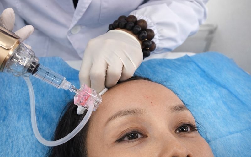 Applications of Multi 9 Pin Needle for Forehead