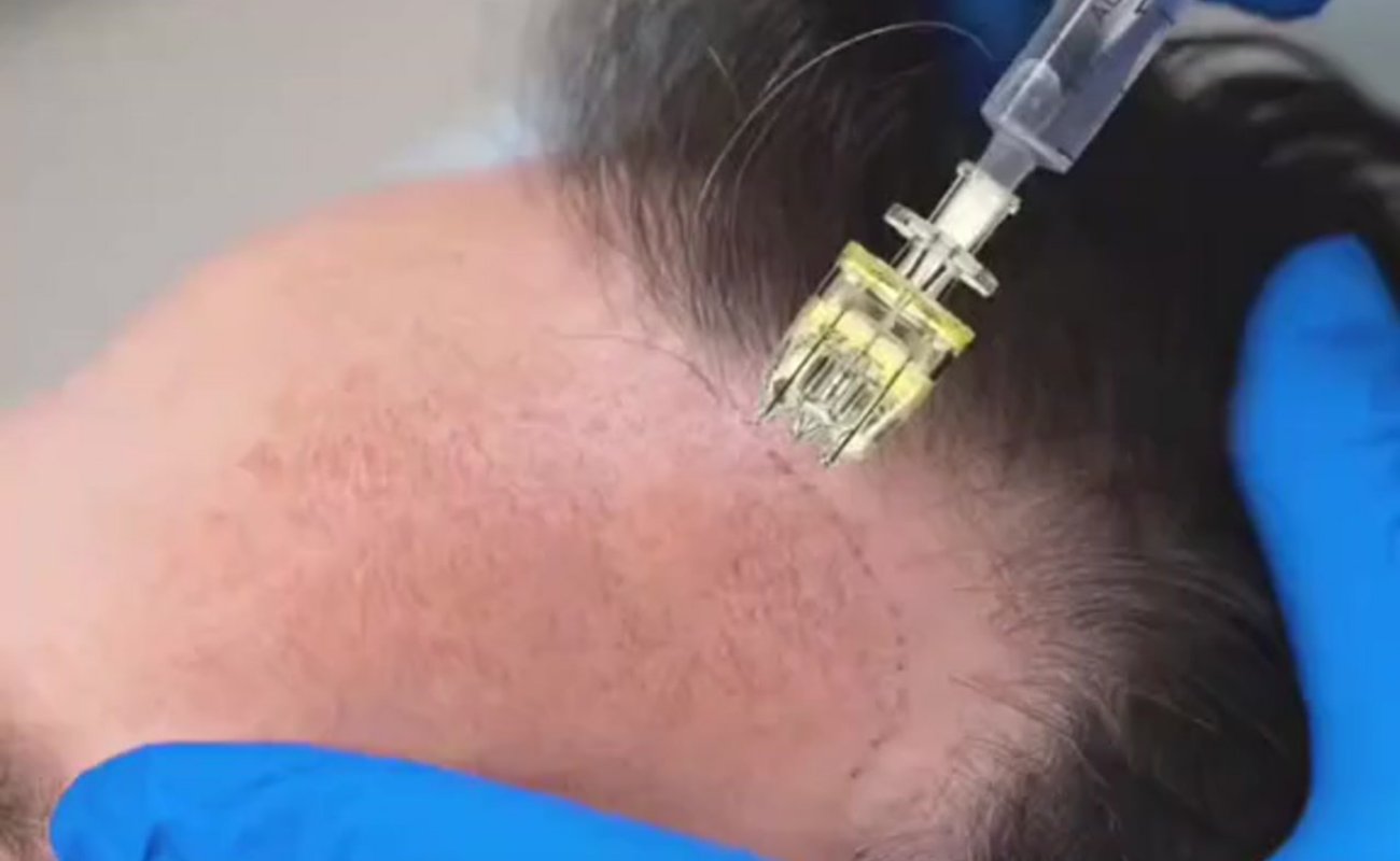 Crystal 5pin Needle for Scalp