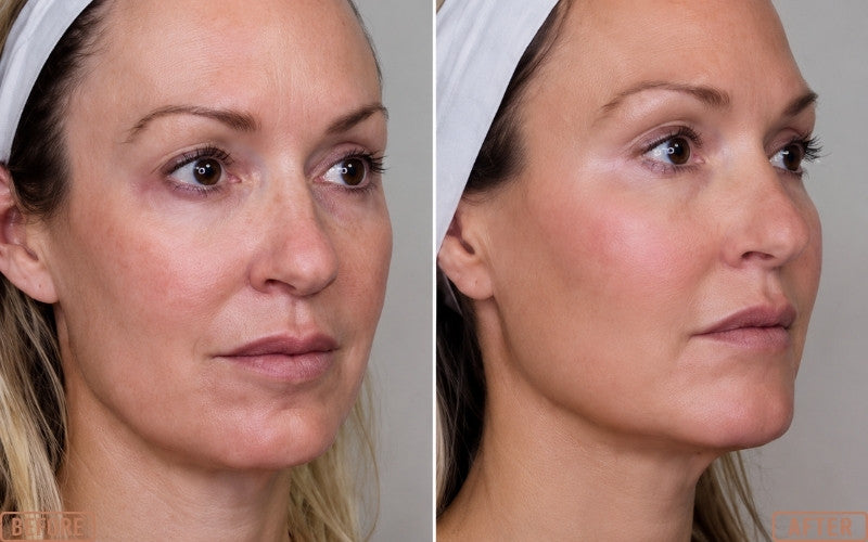 Mesh Threads for Jawline Before and After
