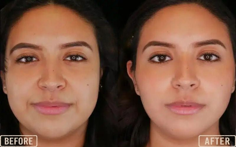 PDO Lip Threads Before and After