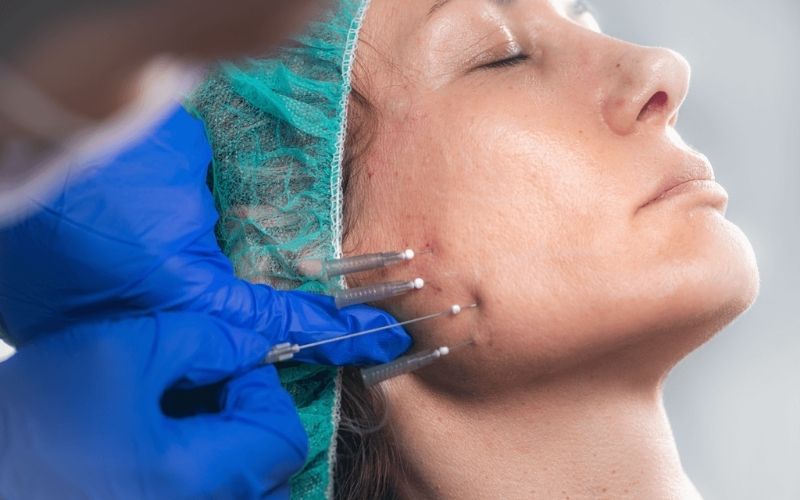 Screw PDO Threads for Cheeks