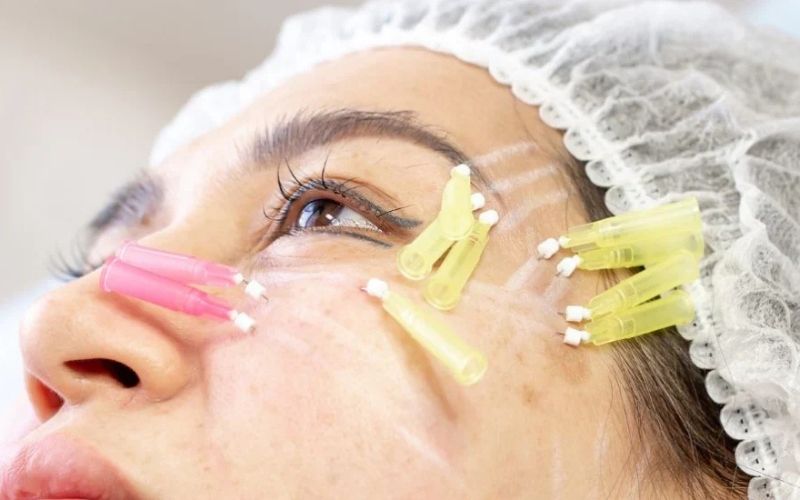 Screw PDO Threads Under Eyes