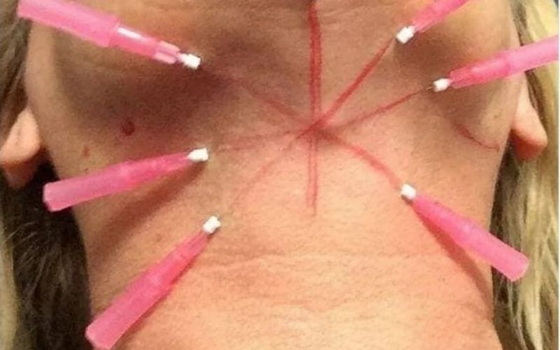Screw PDO Threads for Neck