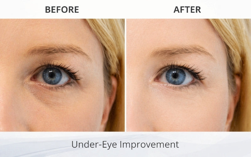 PDO Threads Under Eyes Before and After pc