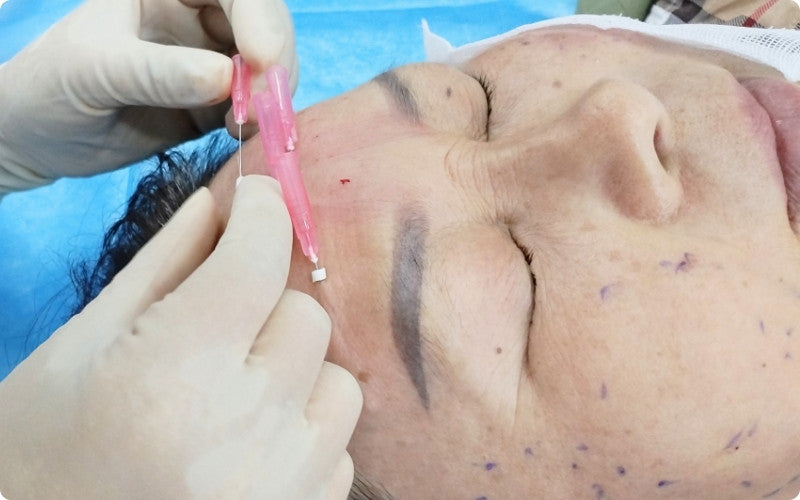 PLLA Smooth Threads for Forehead Wrinkle
