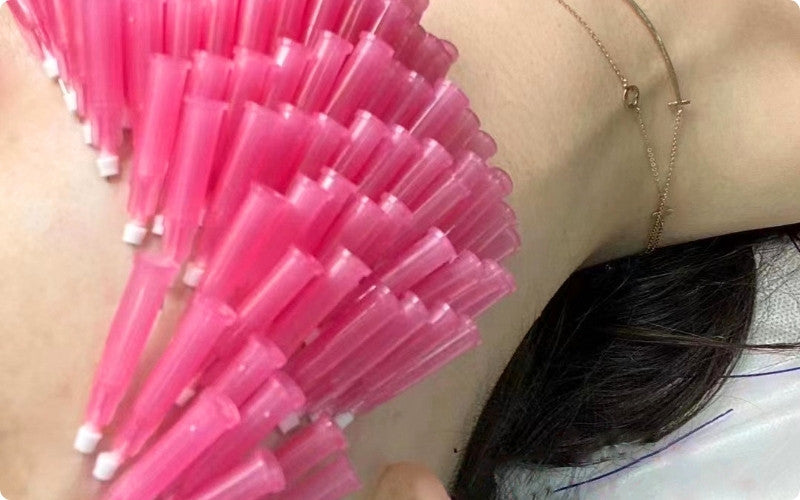 PLLA Smooth Threads for Neck Tightening