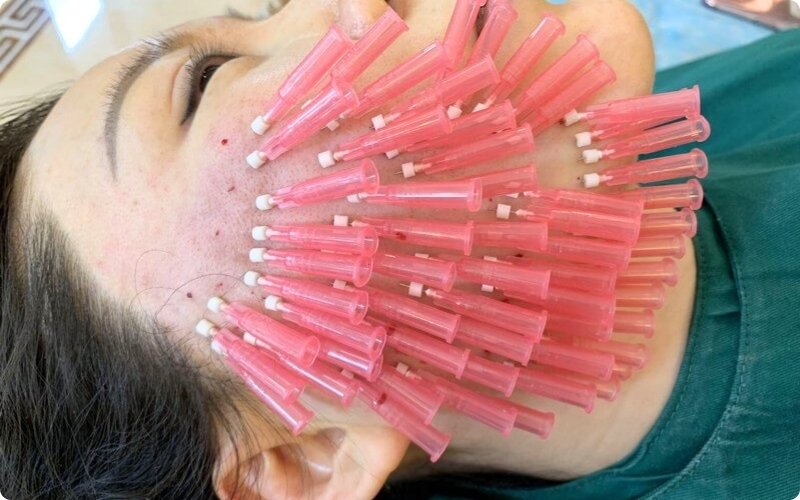 PLLA Smooth Threads for the Face