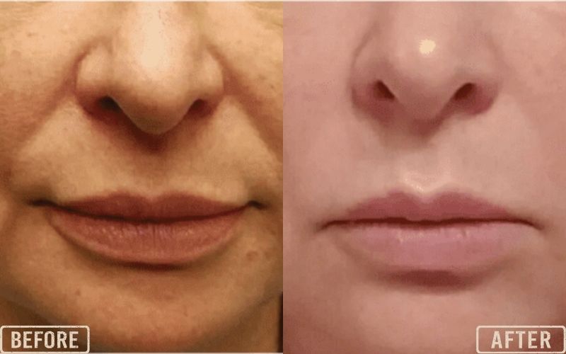 Upper Lip PDO Threads Lips Before and After