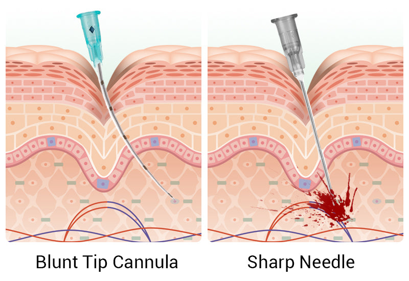 Yastrid 21G Cannula vs. Other Sharp Needle
