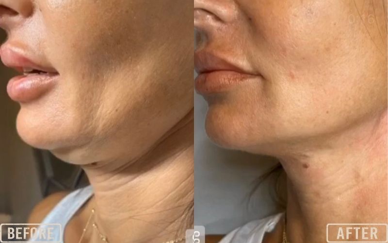 <p style="text-align: center;"><strong>Cog Threads for Jowls</strong></p>