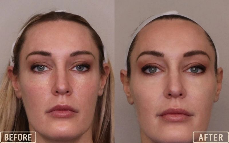 <p style="text-align: center;"><strong>Cog Threads for Nasolabial Folds</strong></p>