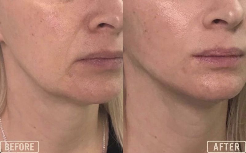 <p style="text-align: center;"><strong>Cog Threads for Neck Lift</strong></p>