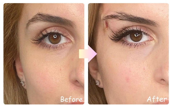 Yastrid Fox Eye Thread Lift Before After