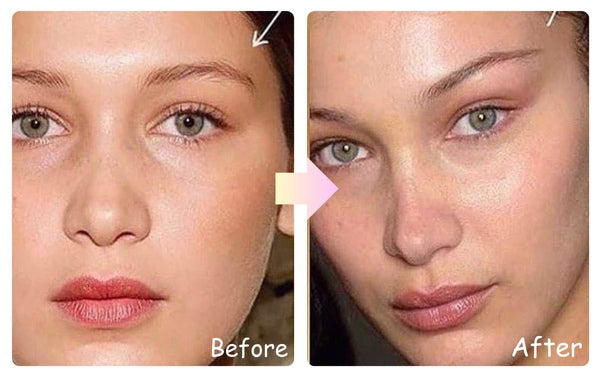 Yastrid Fox Eye Thread Lift Before  and 
After 