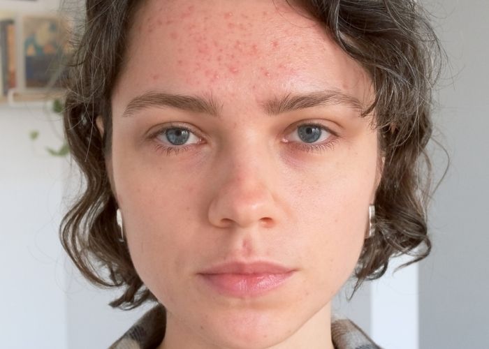 Yastrid LED Light Therapy Before