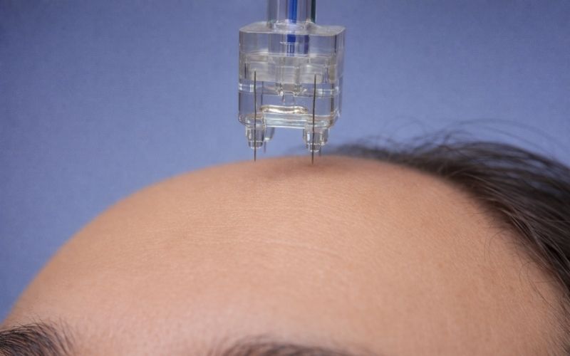 Yastrid Multi Injector Needles 4Pin for Forehead