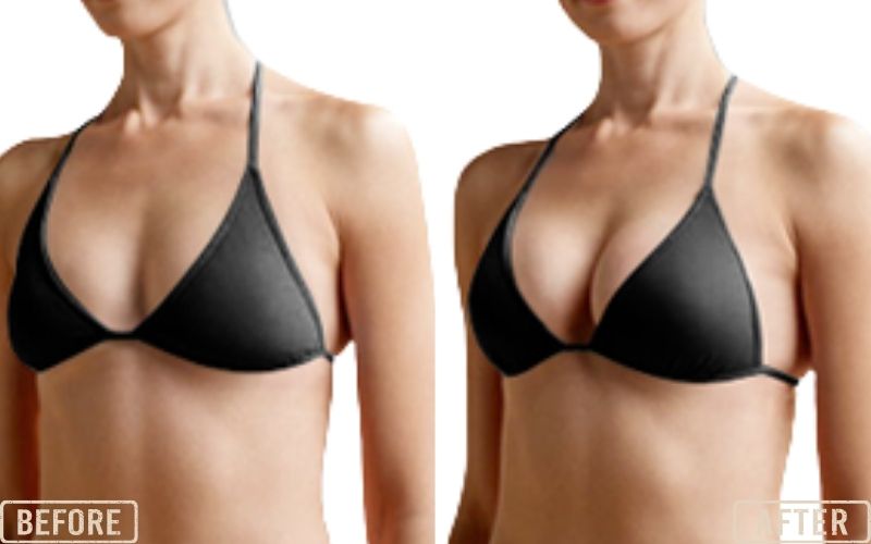 <p style="text-align: center;"><strong>PDO Thread Breast Lift</strong></p>
