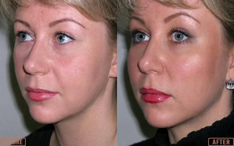 Yastrid Threads for Nasolabial Folds Lift