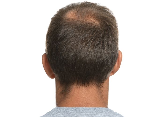 laser hair growth cap before